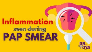 Inflammation Seen on Pap Smear