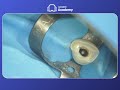 apexification with mta apical plug step by step dental tutorial