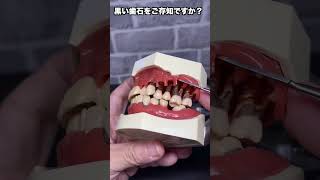 [Totsuka Ekimae Naito Dentistry] Do you know black tartar? ①