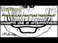 CHAMPY'S LINE OF OSTEOSYNTHESIS II MANDIBULAR FRACTURE II TREATMENT MODALITY II ORAL SURGERY