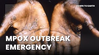 WHO terms latest upsurge of mpox ‘extraordinary’