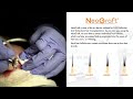 neograft hair transplant fue method dr. lexie wang west end plastic surgery