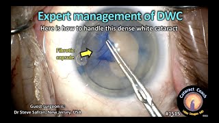 CataractCoach 1515: expert management of a dense white cataract