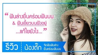 ฟันล่างยื่นคร่อมฟันบนและฟันเขี้ยวหายแก้ไขยังไง?::จัดฟันฟันล่างยื่นคร่อมฟันบนแบบไม่ผ่าตัด