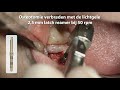 eenfasige plaatsing van een 5 0 x 6 0 mm short® implant voor een molaar in de onderkaak