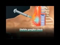 stellate ganglion block stellate ganglion block