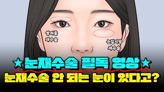 눈 재수술이 불가능한 눈이 있다❓ | 불가능한 CAES를 솔직히 말씀드리겠습니다❗❗