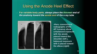 X-ray Technician: The anode heel effect