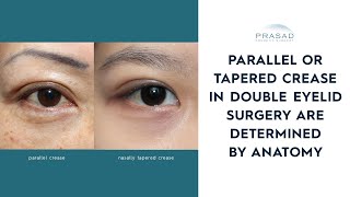 Asian Double Eyelid Surgery - How Anatomy Determines a Tapered or Parallel Crease