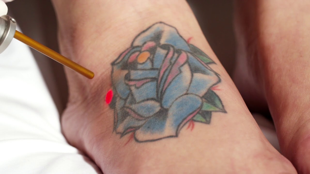 Astanza Eternity Ruby Tattoo Removal Laser System Youtube