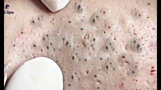 جوش های سرسیاهBlackheads