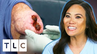 Dr. Lee Removes An Open Wounded Lipoma | Dr. Pimple Popper Pop Ups