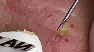 Blackheads Removal | Acne Treatment and Very Satisfying Satisfying Pimple pop #blackheads