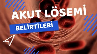 Akut Lösemi Belirtileri Nelerdir? / Akut Löseminin 5 Belirtisi