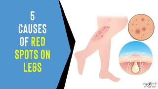 5 Causes of Red Spots on Legs