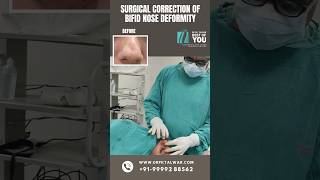 Surgical Correction of Bifid Nose Deformity | Rhinoplasty Surgery in Delhi | Dr. PK Talwar