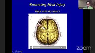 Prognostic Factors in Cranio-Cerebral Penetrating Injuries