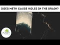 Does Meth Cause Holes in the Brain?