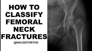 How to Classify Femoral Neck Fractures