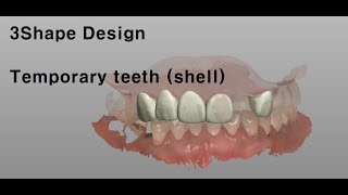 3Shape Design(temp, anterio teeth), 3shape 디자인 전치부 쉘타입 템포 디자인 과정