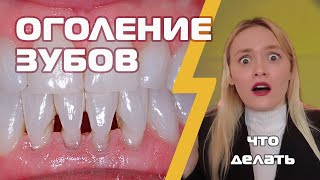 ДЕСНА УХОДИТ и зубы оголяются, что делать, как лечить рецессию десны?