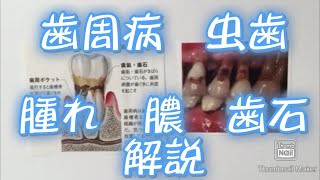 歯周病や虫歯を治療方法　歯茎　腫れた痛い膿　説明動画　クリーニング歯石　大宮鈴木歯科医院　歯医者デンタル歯科クリニック