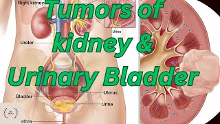Tumors of Kidney & Urinary Bladder/Cancer of Kidney and Urinary Bladder/Ablation & Nephrectomy video