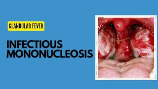 Infectious Mononucleosis