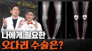 오다리, 그냥 방치하면 관절염까지 올 수 있습니다 I 오다리 수술은 이 영상으로 완벽 이해 가능!