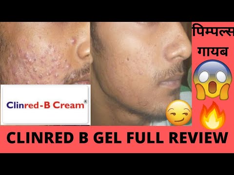 Clinred B Cream Full Review Effects And Side Effects Best For Acne And ...