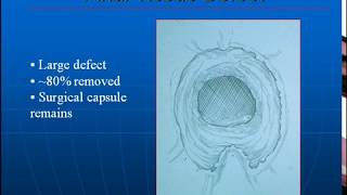 Holmium Laser Enucleation of the Prostate - Initial Experience at Vancouver Hospital