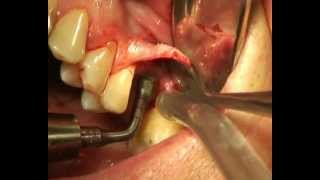 Intralift internal sinus lift procedure