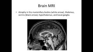 Korsakoff syndrome of psychiatric and alcoholic etiology - Video abstract [ID 203513]