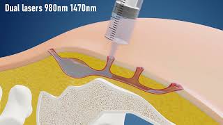 Sinus Laser Ablation Of Pilonidal Cyst SILAC - IBI Healthcare Institute