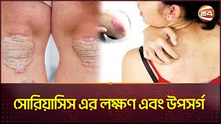 সোরিয়াসিস একটি জটিল ত্বকের রোগ কিন্তু কেন? | Psoriasis | Skin care | Health Care | Channel 24