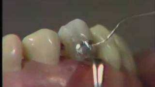 Class V Amalgam Restoration: Finishing and Polishing