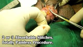 Frenuloplasty Surgery, Tight Ling ki Seal   Stitchless Frenuloplasty, Surat, Gujarat, Mumbai, India