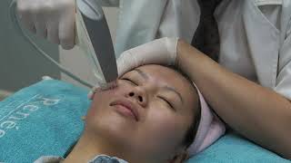 How Sublative Laser Permanently Treat Acne Scar?