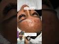 Zahira pimple remove cream fast results & pigmentation remove #shortvideo #shorts #short