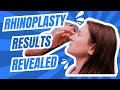 Rhinoplasty for Thick Skin | Westlake Plastic Surgery Transformation