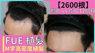 【韓國植髮分享】 FUE 植髮│2600根│術后12個月成果│Hair transplant in Korea│FUE follicular unit extraction │Result