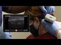 scanning technique occipital nerve block