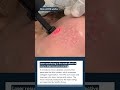 acne scarring with eco2 laser laser scarring acnetreatment