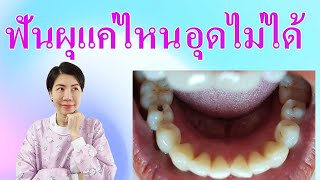 ฟันผุขนาดไหนอุดไม่ได้