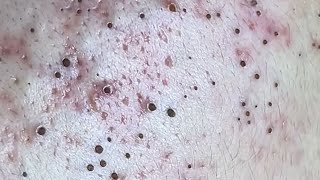 Suri Job #668: Awesome Stubborn Blackheads Extraction