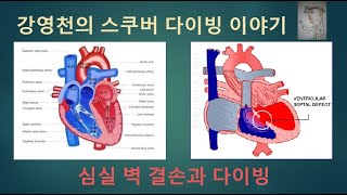 강영천의 스쿠버 다이빙 이야기 - 심실벽결손과 다이빙