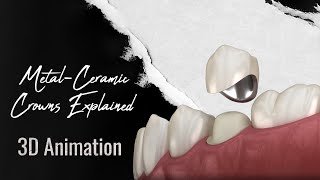 Metal-Ceramic Crowns Explained: 3D Animation of Porcelain-Fused-to-Metal Restorations