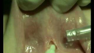 Doctor Smile laser- frenectomy operation/operazione di frenectomia