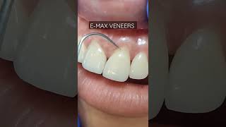 Get your smile corrected with E-Max veneers #veneers #porcelain #emaxveneers #dentalphotography