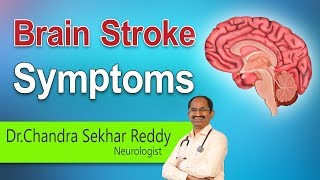 Hi9 | Brain Stroke Symptoms - Dr.Chandra Shekar Reddy, Neurologist